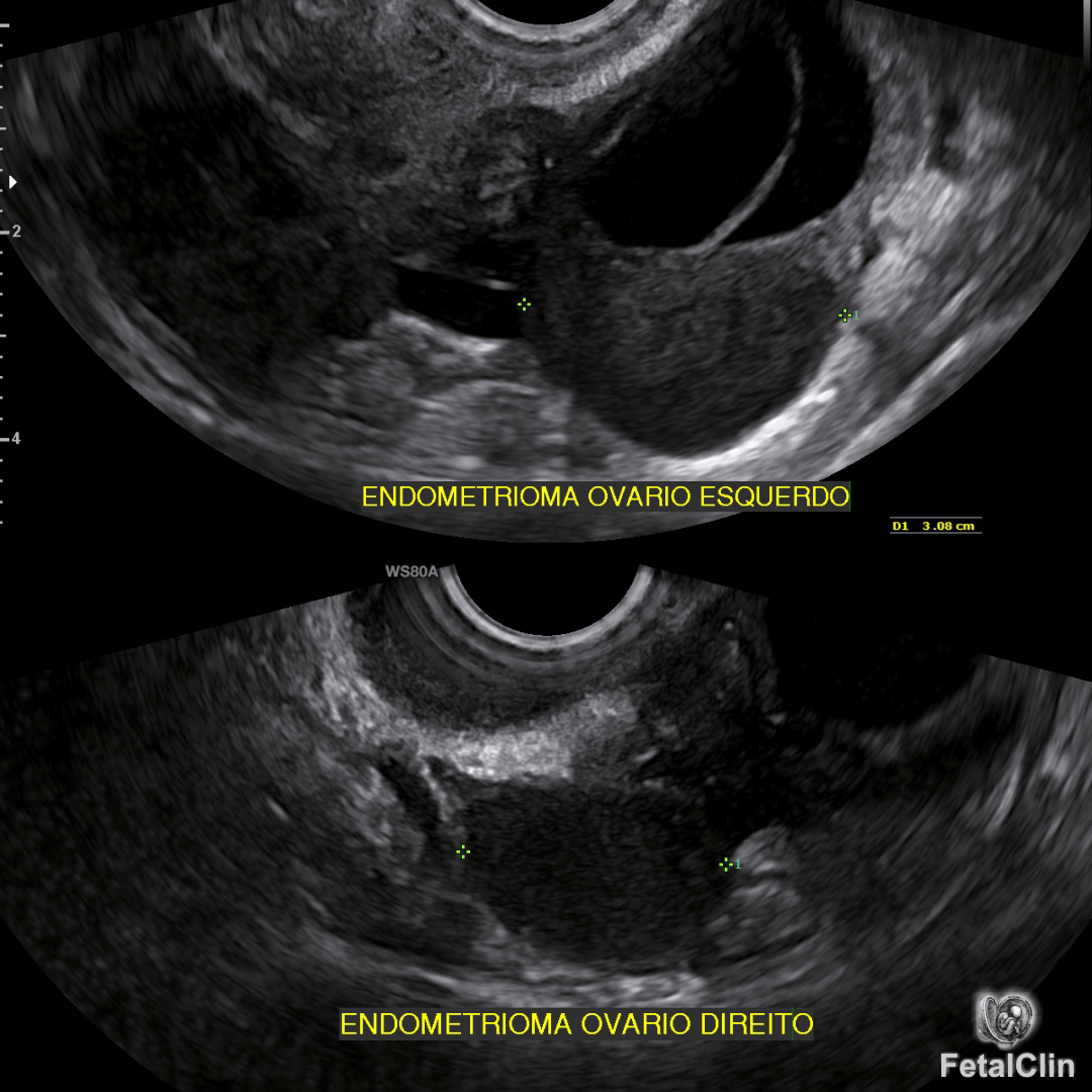 Endometriose