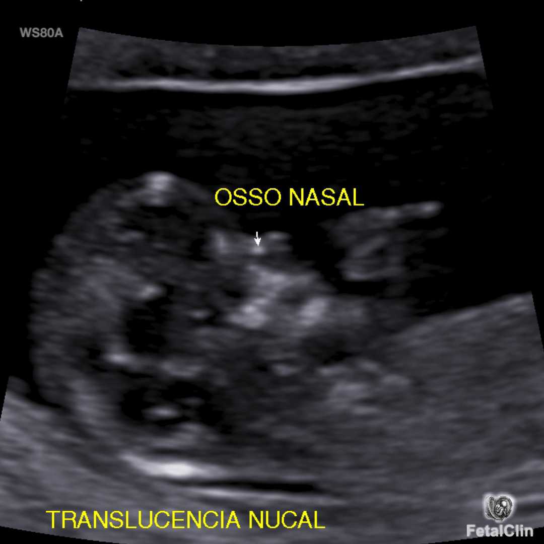 Transluscencia nucal