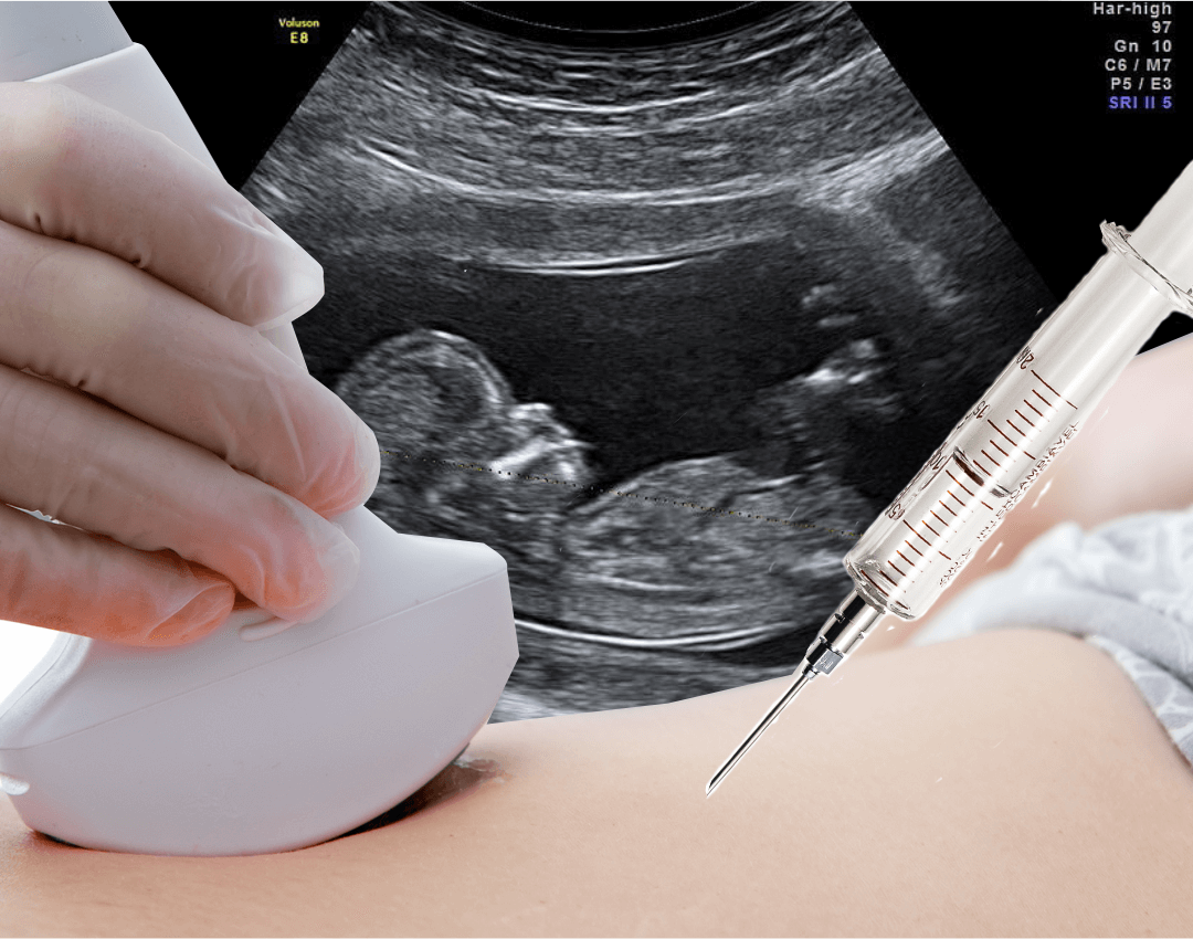 Amniocentese - FetalClin > Medicina Fetal em União da Vitória